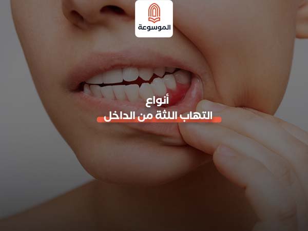 أنواع التهاب اللثة من الداخل